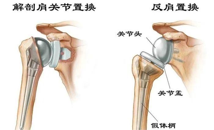 反肩关节置换有哪些优势？